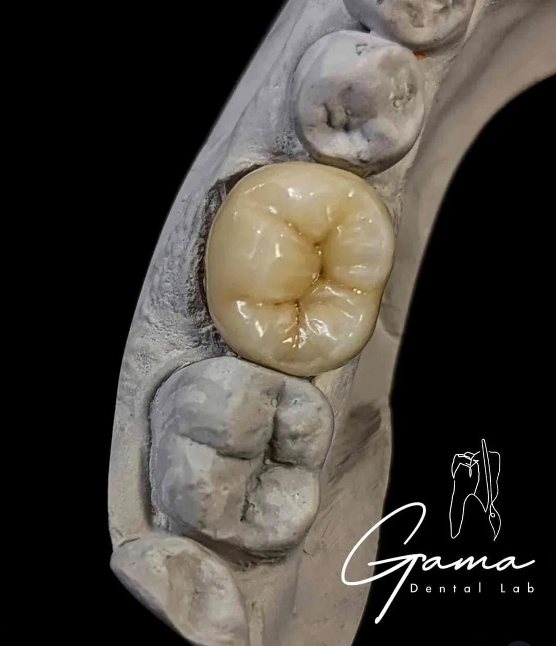 Incrustación en porcelana